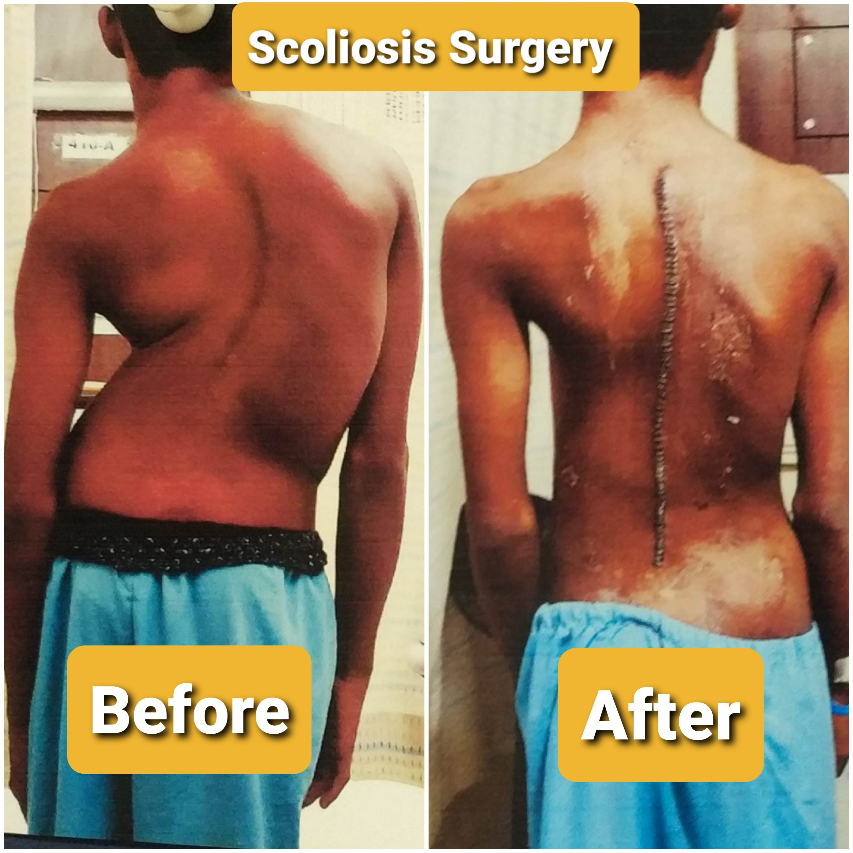 scoliosis Surgery